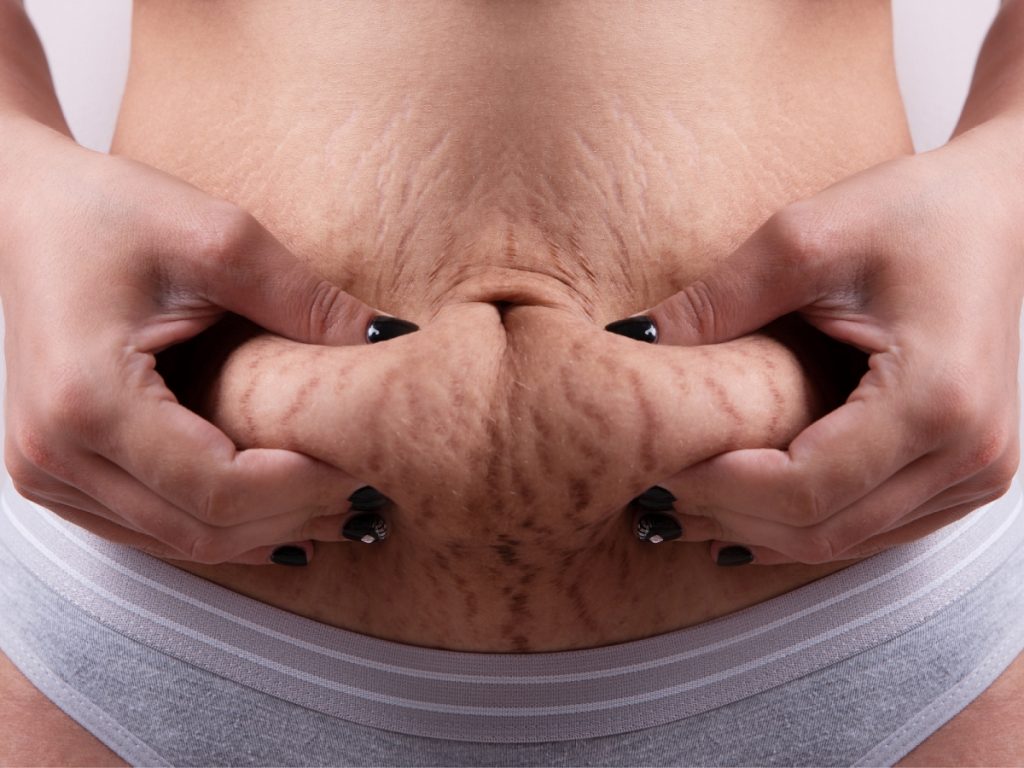 Can Laser Treatment Reduce Stretch Marks