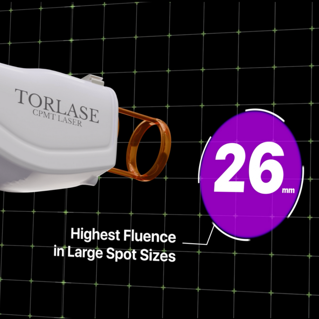 Torlase- Highest Fluence in Large Spot Size