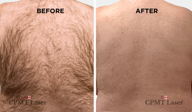 Quadruple Laser technology before after