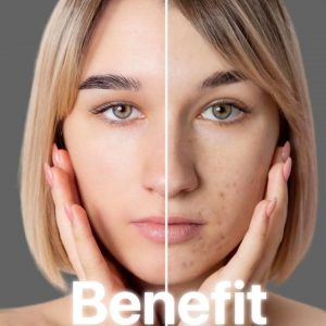 Acne Treatment