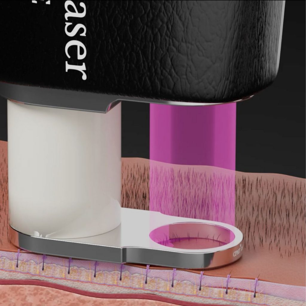 Laser Hair Removal Treatments