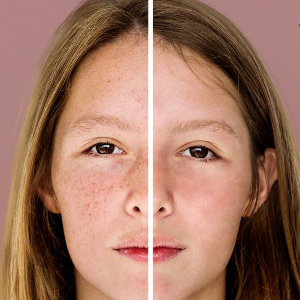 Facial Treatment Machines