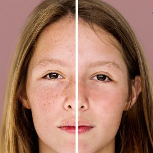 Facial Treatment Machines