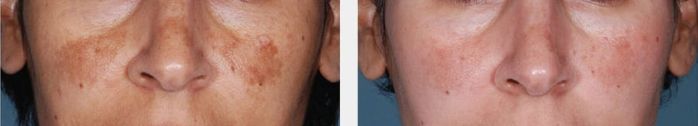 Best Pigmentation Treatment Machines