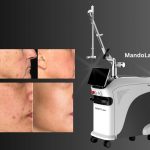 best pigmentation treatment machine