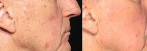 Best Pigmentation Treatment Machines